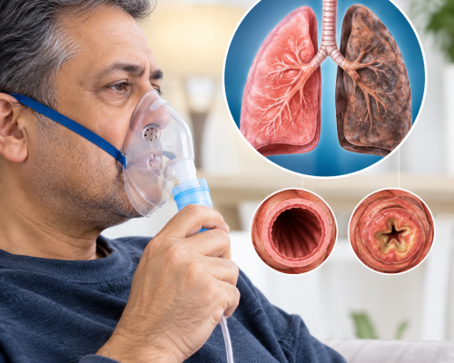 COPD specialist doctor in Rajouri Garden Delhi COPD treatment in Rajouri Garden Delhi chronic obstructive pulmonary disease doctor Rajouri Garden COPD specialist near me